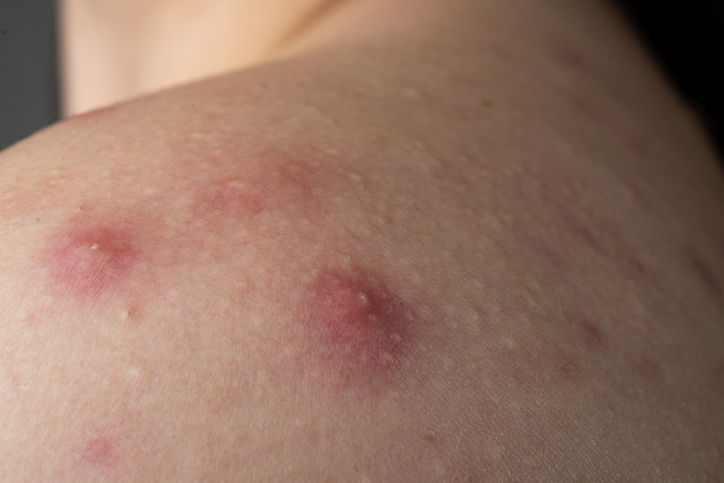 MRSA 피부 감염이 여드름, 종기, 고름집처럼 보이다가 통증과 열감이 심해질 수 있음을 설명하는 이미지