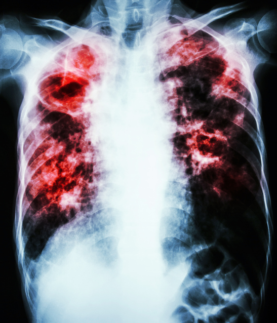 MRSA 감염이 피부 감염에서 혈액 감염, 폐렴, 뼈와 관절 감염으로 악화될 수 있음을 설명하는 이미지